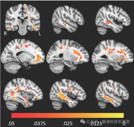 往期精彩|J. Magn. Reson. Imaging:来自弥散成像的退行性脑疾病的MR生物标志（研究综述）