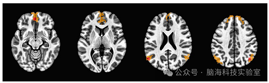 Alzheimers & Dementia：成人唐氏综合症患者心肺健康与静息态功能连接之间的关联