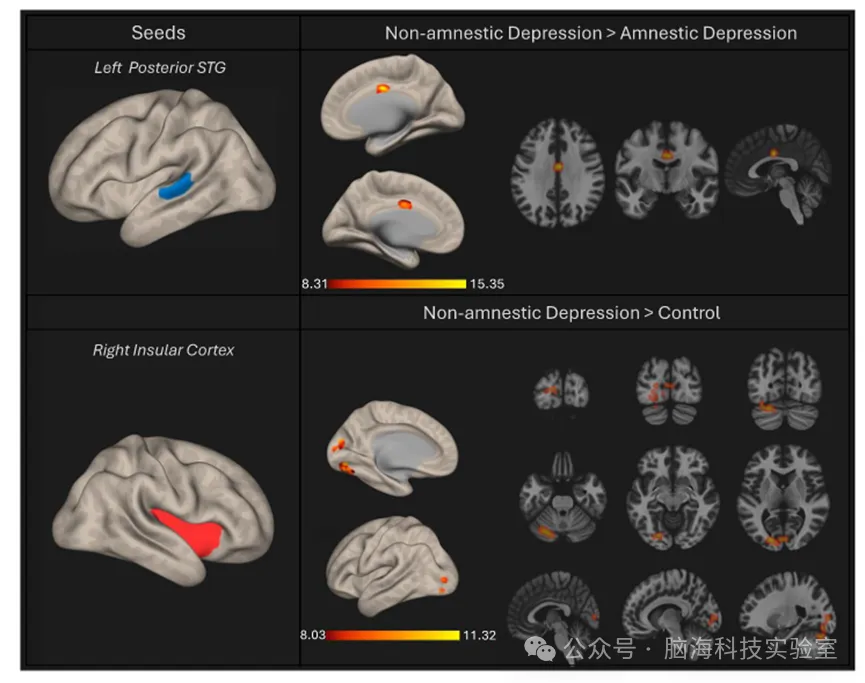 Transl. Psychiatry：重度抑郁症患者的主观认知能力下降与熵改变以及颞叶和岛叶区域的连通性变化有关