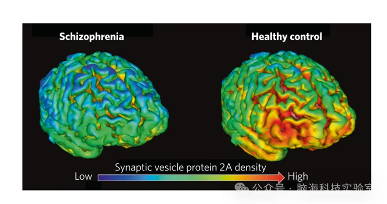 Neuropsychopharmacol：精神分裂症的神经影像学检查：研究结果概述及其对突触变化的影响