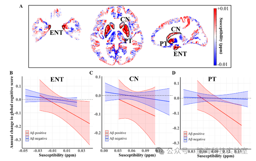 Radiology：QSM分析MRI脑部铁沉积可以预测认知障碍和衰退