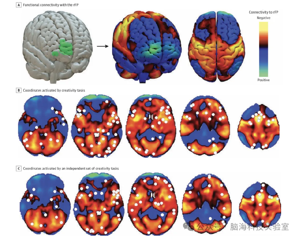 往期精彩|JAMA Network Open：MRI 映射确定创造力的大脑回路