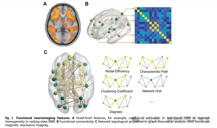 Transl Psychiat：注意缺陷/多动障碍中的机器学习：理解神经机制的新方法