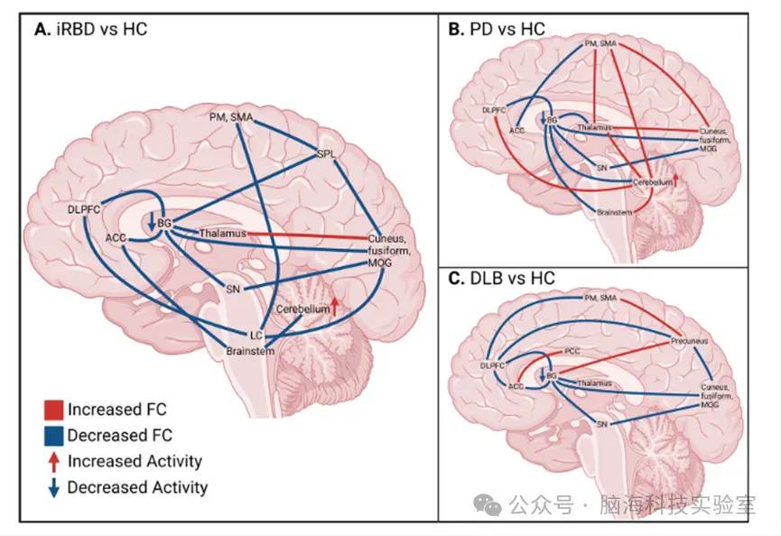 Mov Disord.：通过功能磁共振了解快速眼动睡眠行为障碍:系统回顾