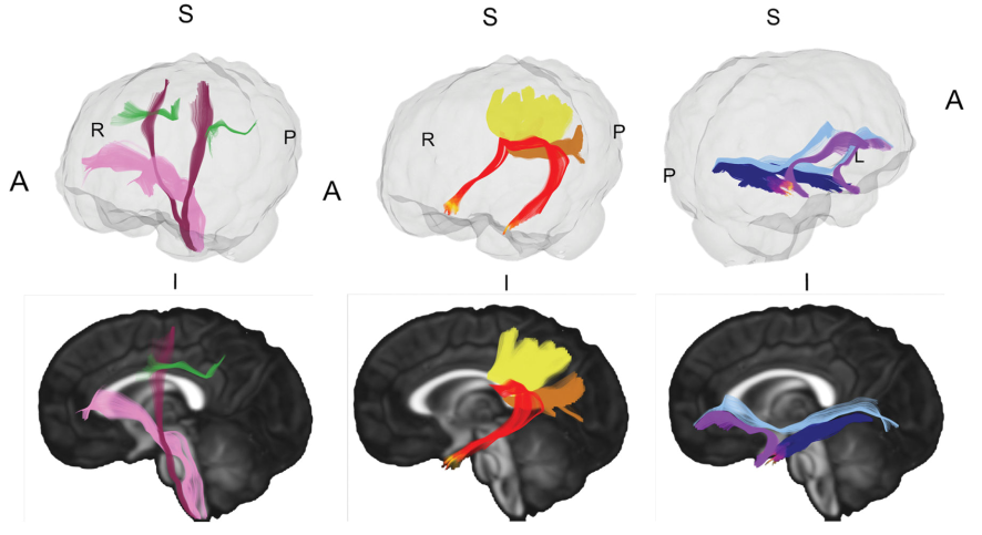 Neuroimage：唐氏综合征婴儿早期的白质微结构改变一项NODDI神经影像研究