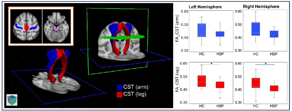 Journal of Neurology：脑结构改变对纯遗传性痉挛性截瘫4型患者运动体征的影响