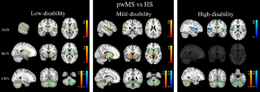 Journal of Neurology：功能连接改变与多发性硬化残疾进展相关：一项纵向fMRI研究