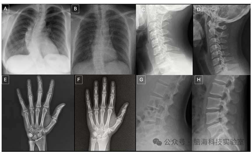 Radiology：AI生成的医学图像可欺骗资深放射科医生