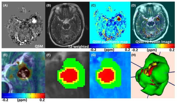 Epilepsia：散发性脑海绵状血管畸形相关癫痫中铁沉积的定量磁化率成像