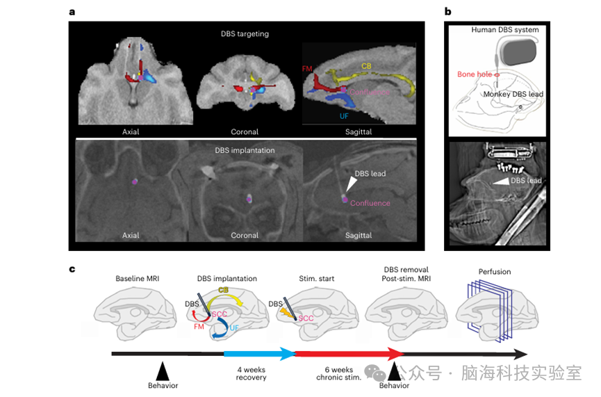 Nature Neuroscience：DBS重塑白质逆转抑郁的路径