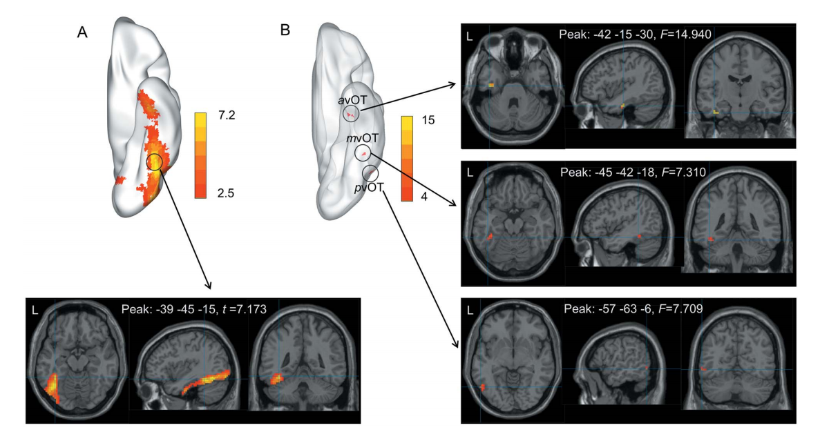 脑结构皮层重建与分割系统
