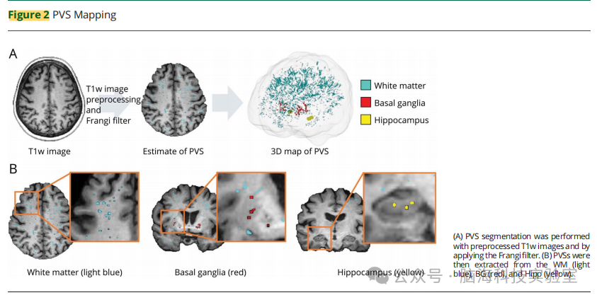 轻度认知障碍和阿尔茨海默病中淋巴系统MRI指标与淀粉样蛋白沉积和认知的关系