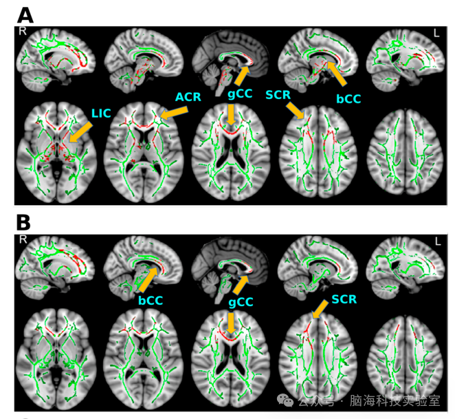 应用弥散张量成像和支持向量机检测慢性爆炸相关轻度颅脑损伤