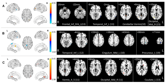 Epilepsia：新发现！MRI扫描可精确定位癫痫患者脑病变部位