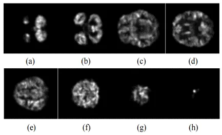 J Integr Neurosci：基于XGBoost的精神分裂症灰质磁共振成像研究