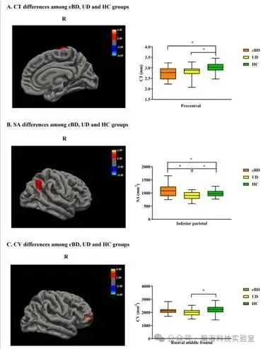 J Affect Disorders：单双相抑郁的脑结构趋异与趋同：基于表面形态测量分析的发现