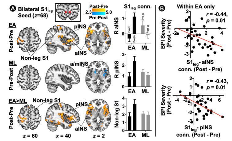 Arthritis Rheumatol：为什么针灸能缓解纤维肌痛？大脑研究发现关键在这里
