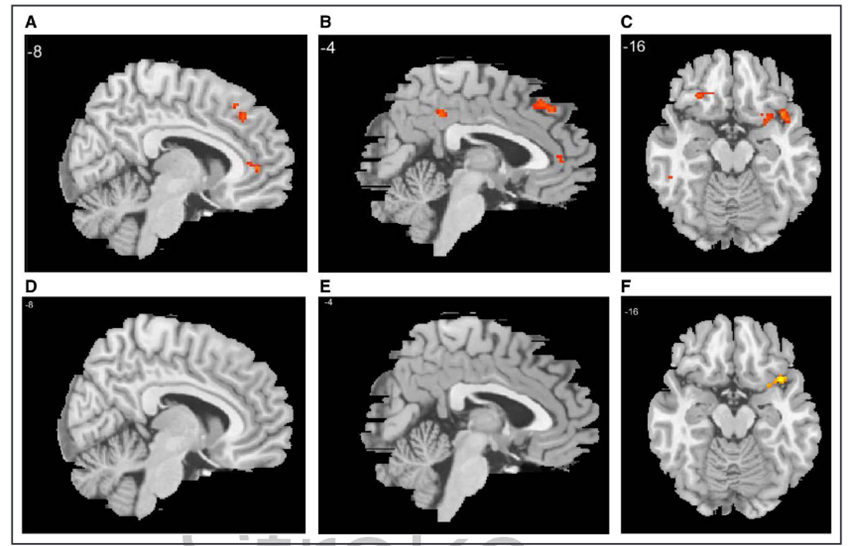 Stroke：中风后尿失禁的神经机制：一项功能磁共振成像研究的结果