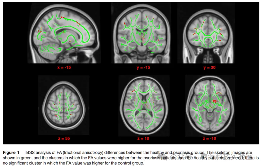 J Eur Acad Dermatol Venereol.: 为什么一想到痒，牛皮癣患者就更痒？大脑研究揭示了原因
