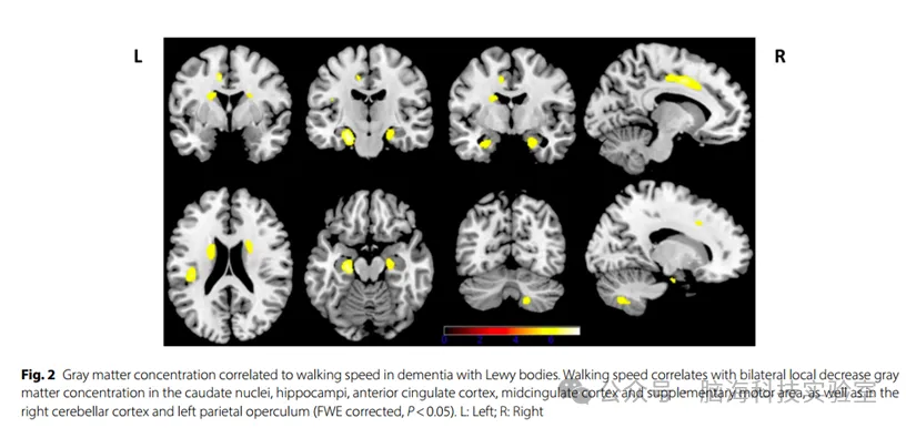 Alzheimers Res Ther.：为什么路易体痴呆患者走路会不稳？大脑研究找到了原因
