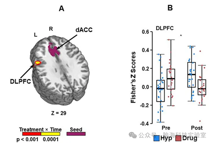 Am J Obstet Gynecol：为什么催眠疗法能治女性尿失禁？大脑研究揭示了其中的奥秘