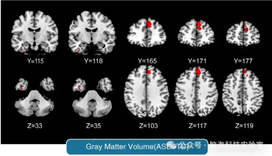 自闭症合集 | 以往高分文献分析，揭示自闭症研究热点