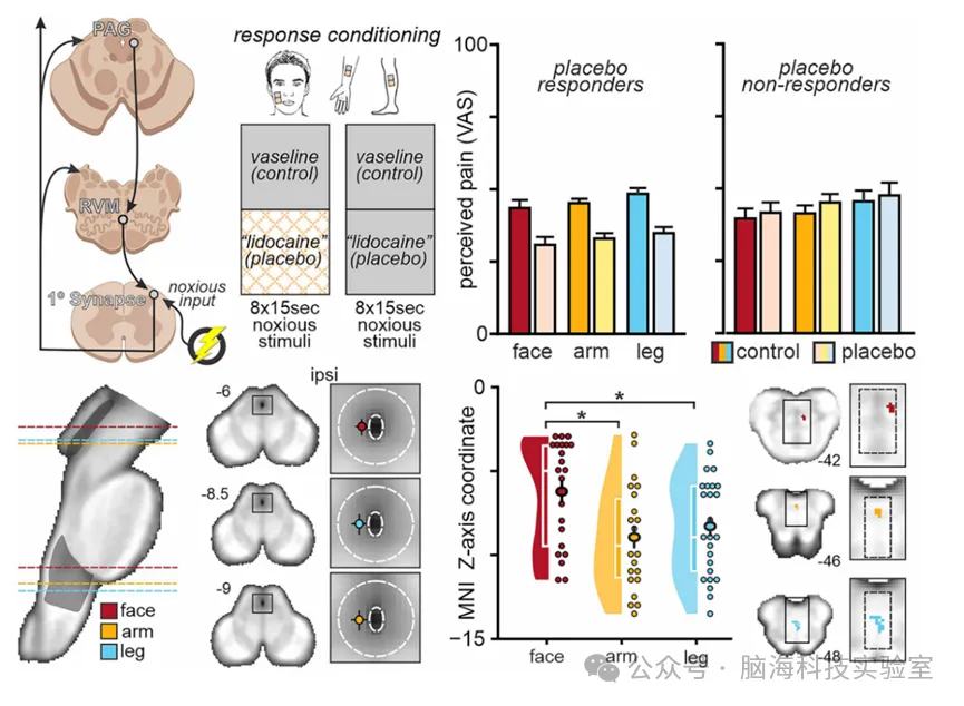 Science:新发现 !安慰剂缓解疼痛的作用在人体中各有不同