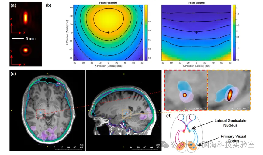 Nature Communications:新技术!超声头盔可在无需手术的情况下实现对人脑深部的刺激