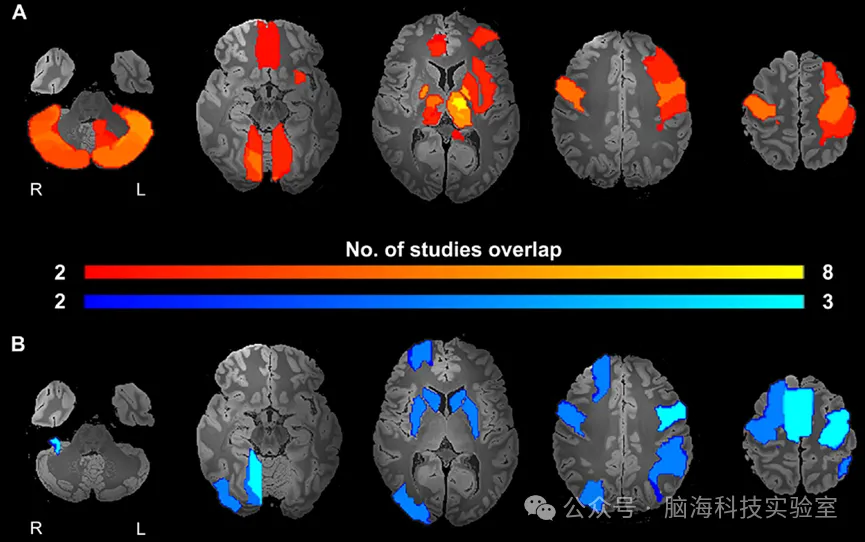 Brain Stimul：利用功能磁共振成像探究脑深部刺激的反应