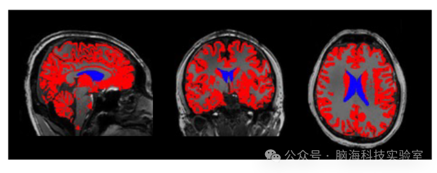 PANS：深度睡眠通过脑脊液和神经节律巩固记忆