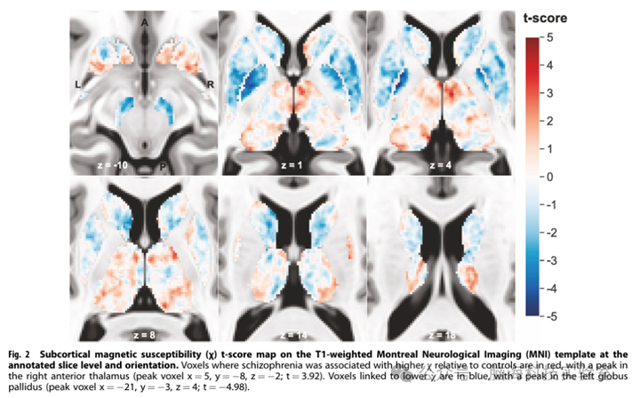 Mol Psychiatr：精神分裂症与大脑铁元素及髓鞘含量不足有关