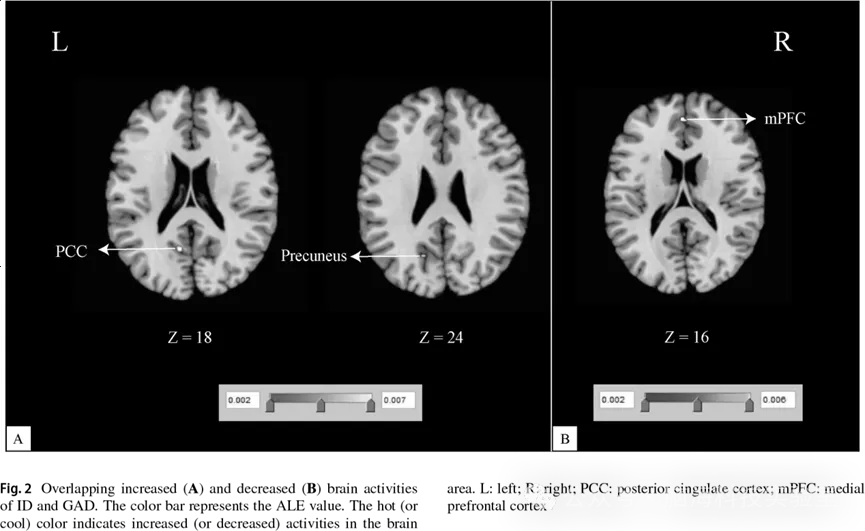 Brain Imaging Behav：失眠与广泛性焦虑障碍静息态脑活动的比较：一项基于坐标的元分析