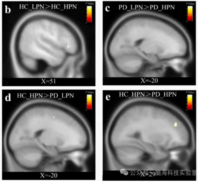 J Affect Disorders:童年创伤对惊恐障碍患者脑灰质体积的影响