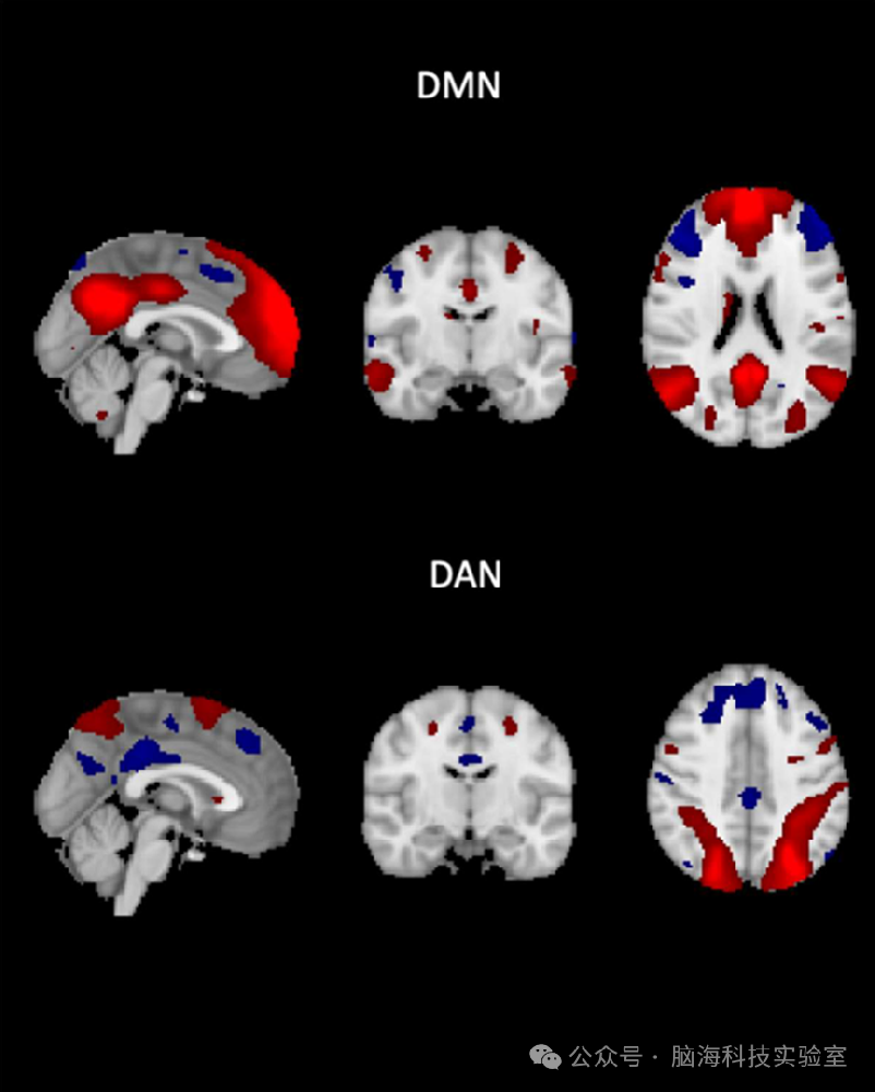 NeuroImage：DMN-DAN大脑网络抗相关性揭示阿尔茨海默病病理新机制