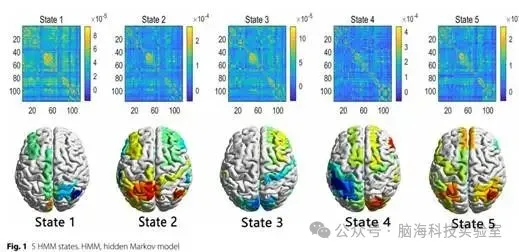 往期精彩|J Transl Med：颞叶癫痫中的动态功能连接和基因表达相关性：来自隐藏马尔可夫模型的见解