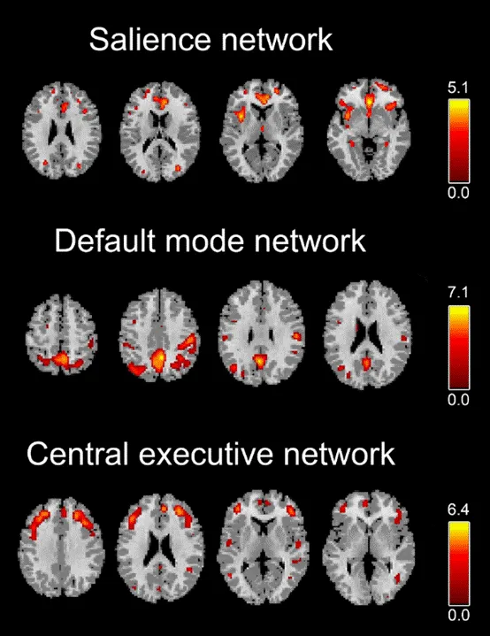 往期精彩|J Affect Disorders:电休克治疗后通过结构网络成像分析重度抑郁症患者与健康对照者的三重网络连接变化