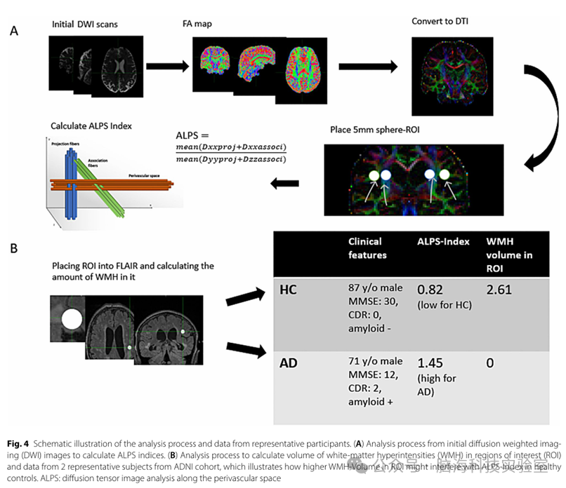 往期精彩|Alzheimers Res Ther:DTI-ALPS指数!破解阿尔茨海默病淋巴功能障碍的生物标志物!