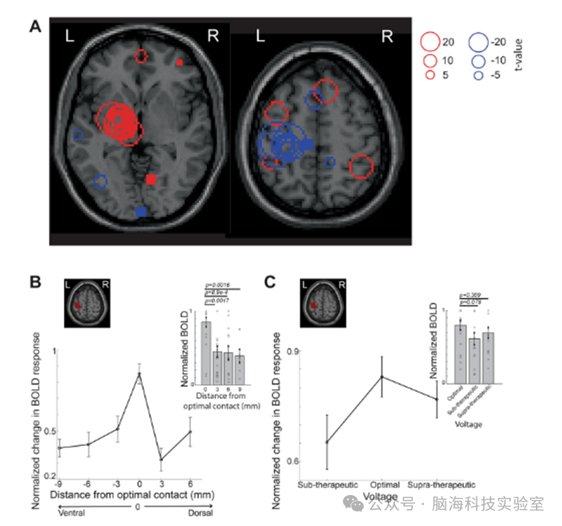 往期精彩|Nature子刊:利用功能磁共振成像和机器学习预测帕金森病的最佳脑深部电刺激参数