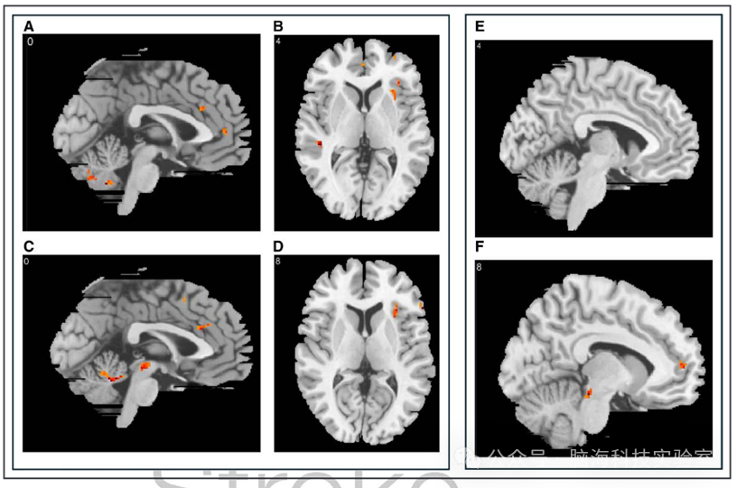 往期精彩|Stroke：中风后尿失禁的神经机制：一项功能磁共振成像研究的结果
