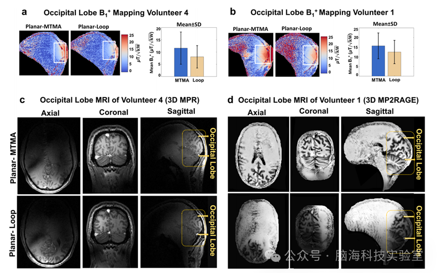 Adv. Mater.：新研究！超材料核磁天线可以提高图像质量，缩短扫描时间，且无需更换机器