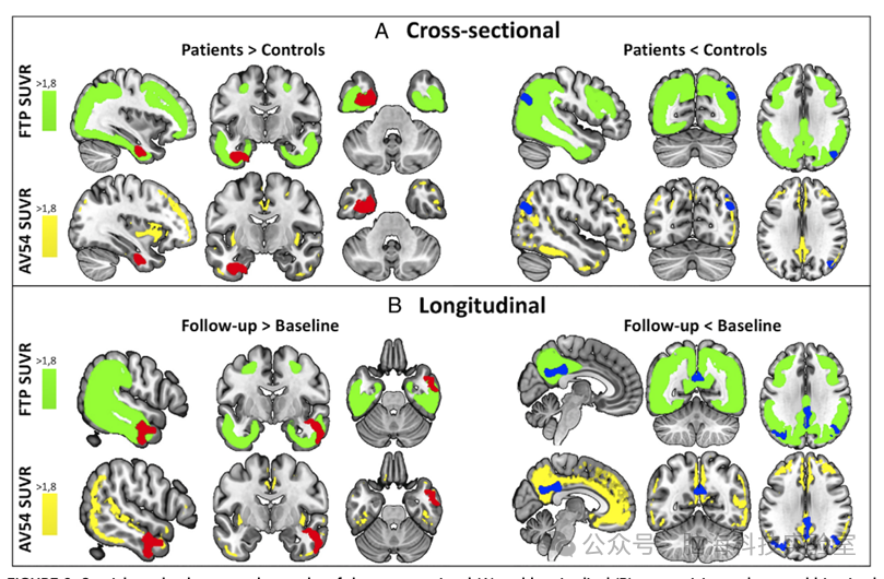 往期精彩|Ann Neurol: 阿尔茨海默病中海马体网络连接的纵向变化