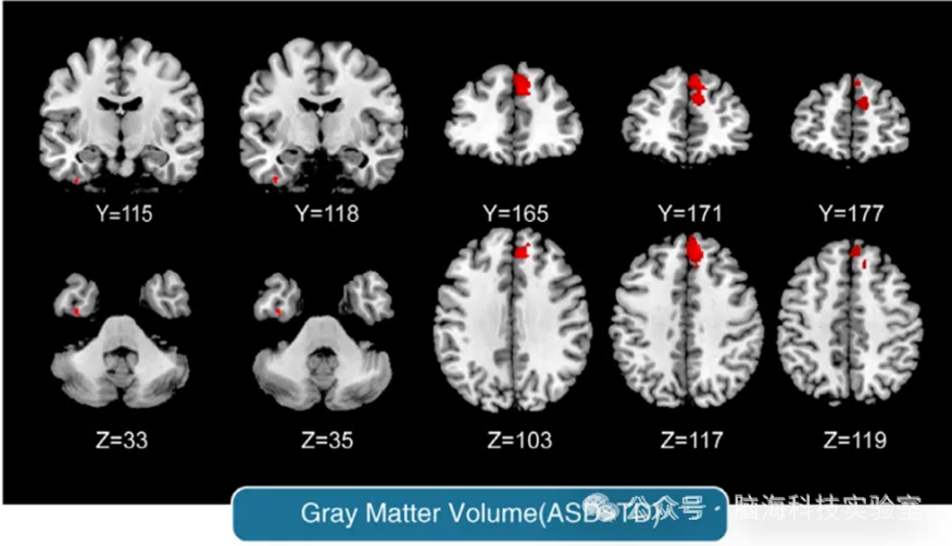 往期精彩|自闭症合集 | 以往高分文献分析,揭示自闭症研究热点