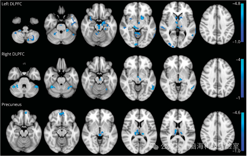 往期精彩|帕金森合集 | 以往高分文献分析，揭示帕金森研究热点