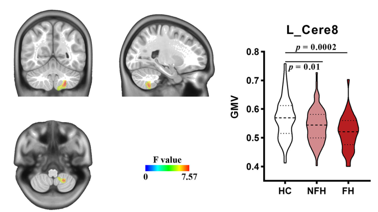 Transl. Psychiatry：家族史、炎症与小脑在重度抑郁症中的作用：一项结合VBM与动态功能连接的研究