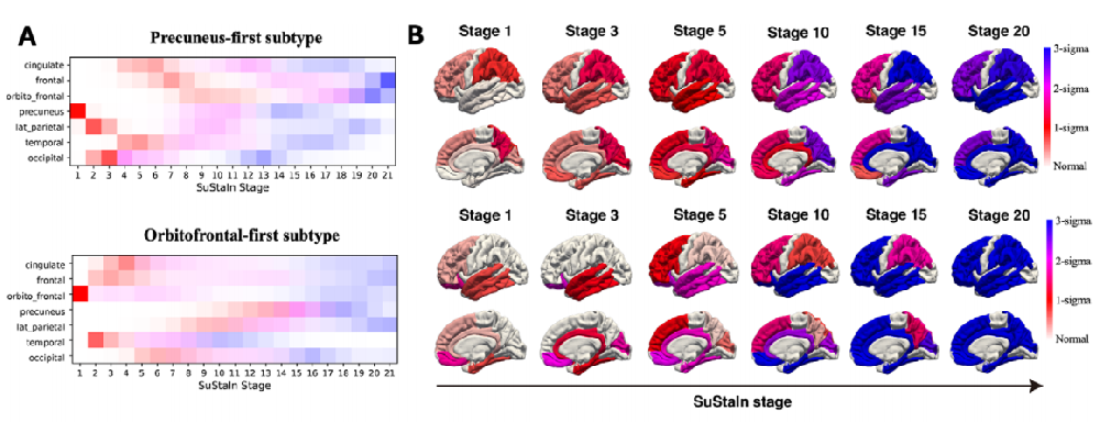 Radiology：使用扩散 MRI 衍生的自由水分数识别阿尔茨海默病中近皮质微结构的独特时空模式